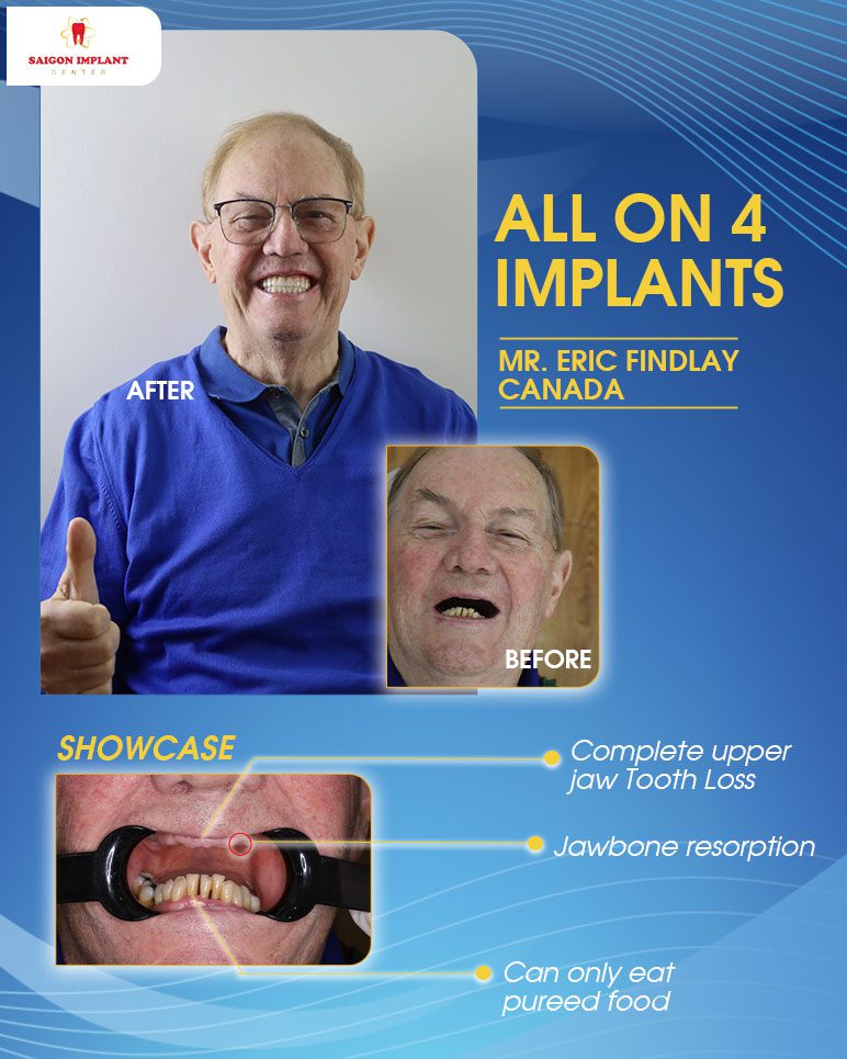 all on 4 dental implants