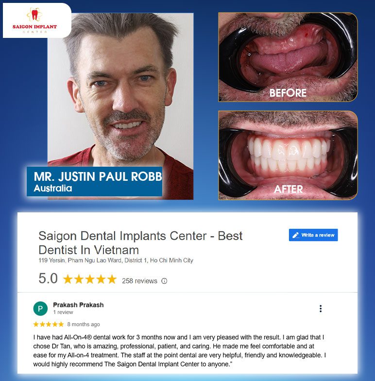 customer reviews dental implants