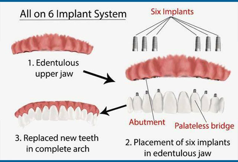 what is all on 6 implant