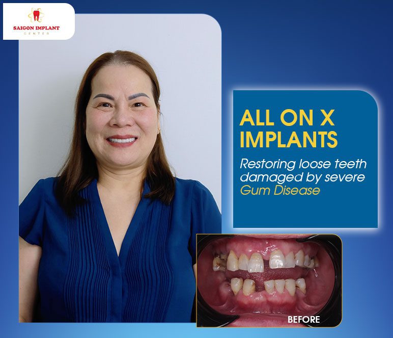 dental implants