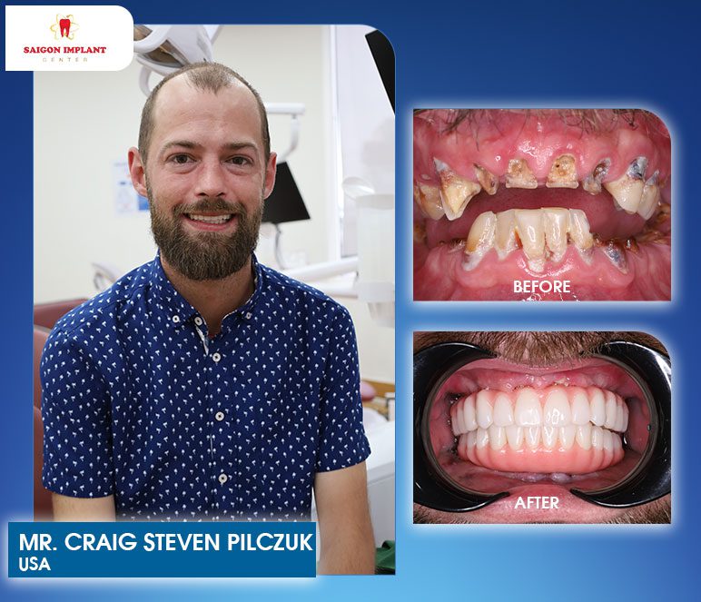 dental implant before after