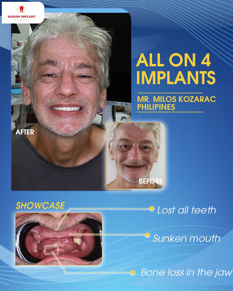 full mouth dental implants