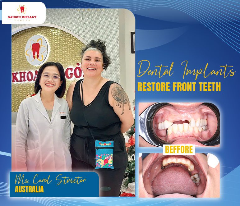 dental implants before after