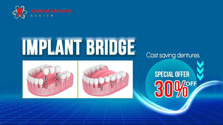 implant birdge