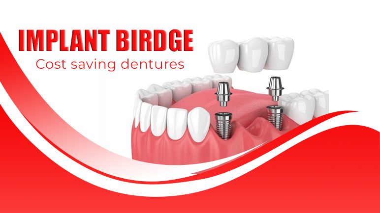 implant bridge