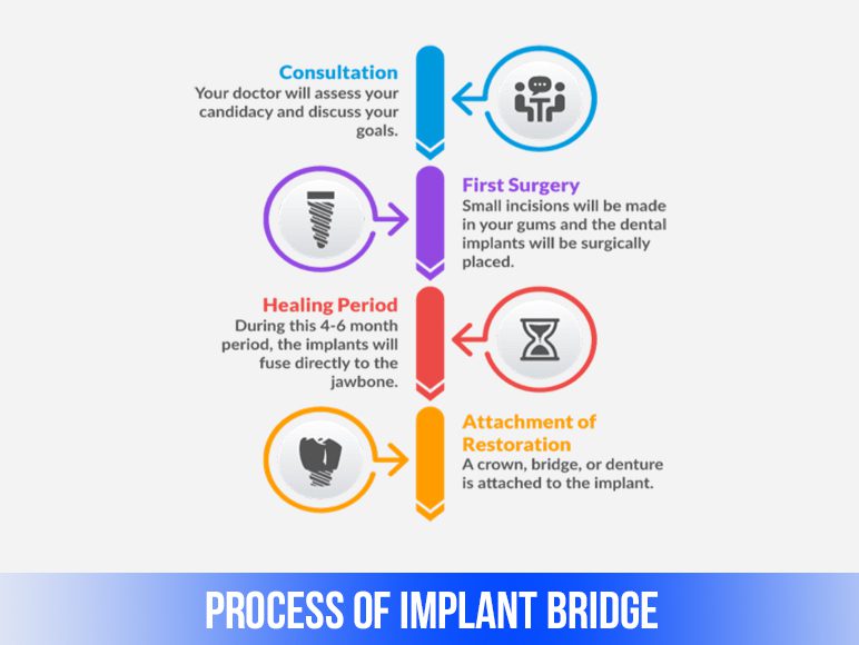process of dental bridge implant