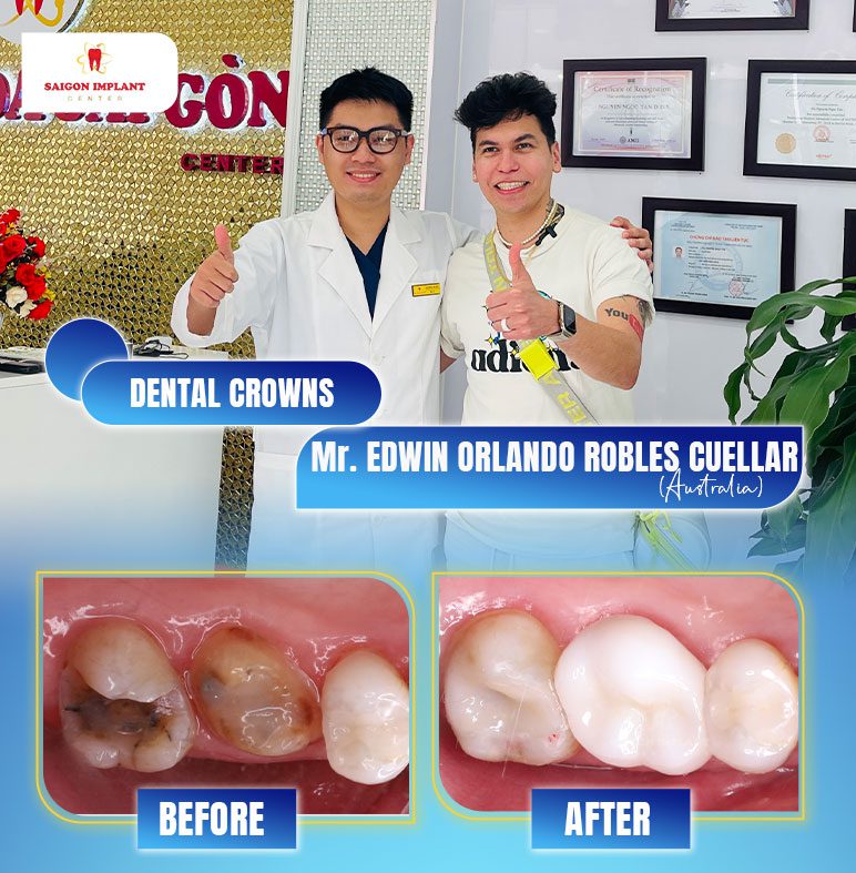 root canal treatment
