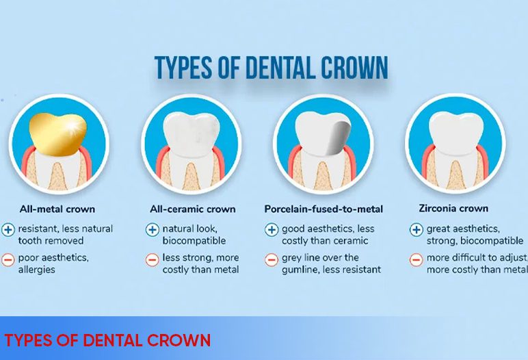 type of dental crown