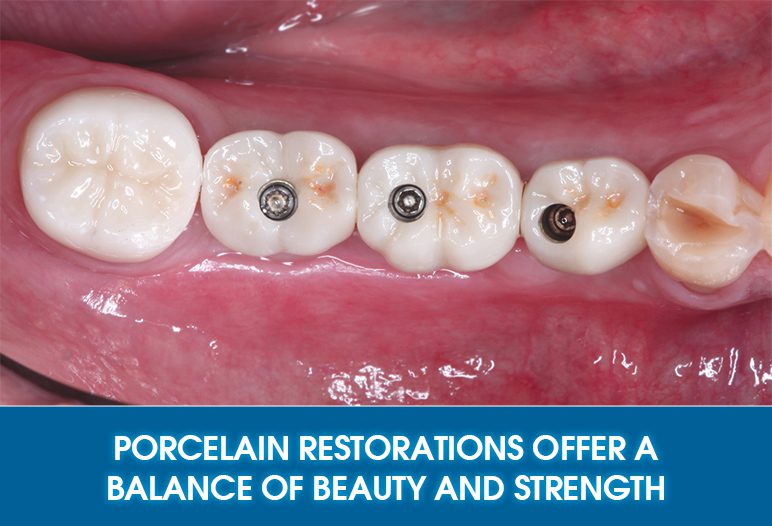 porcelain crown on implants