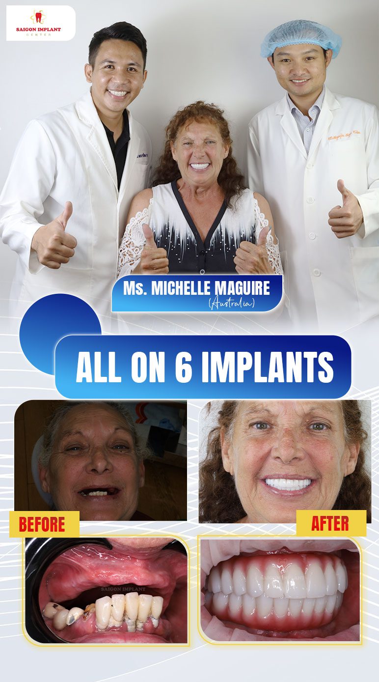 getting dental implants in vietnam