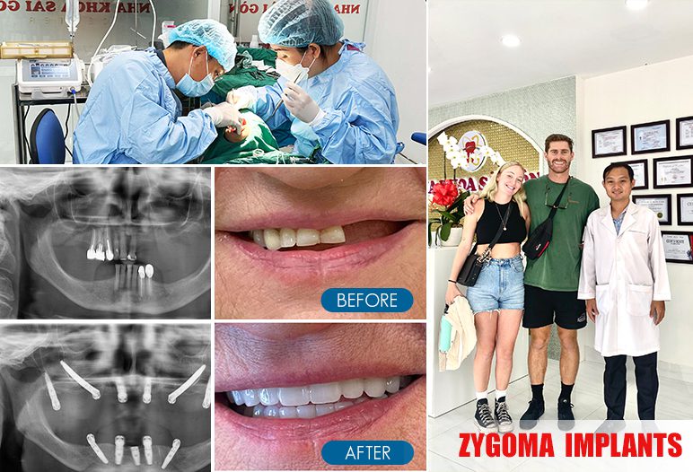 zygomatic dental implants