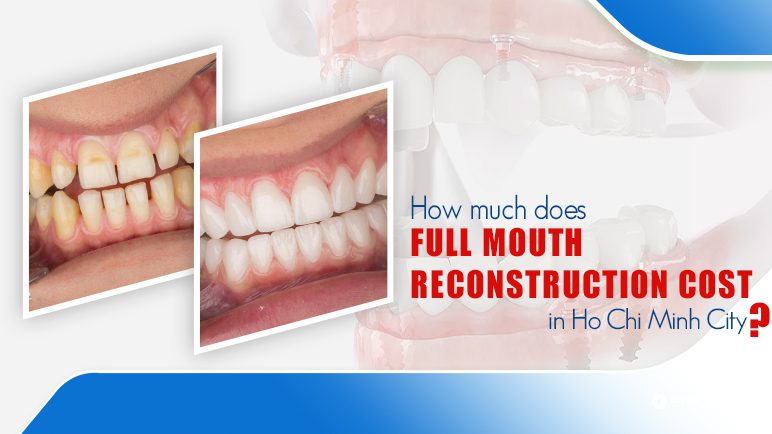 full mouth reconstruction cost
