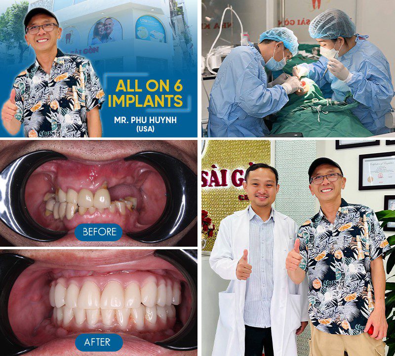 dental implants before and after
