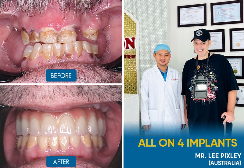 dental implants before and after