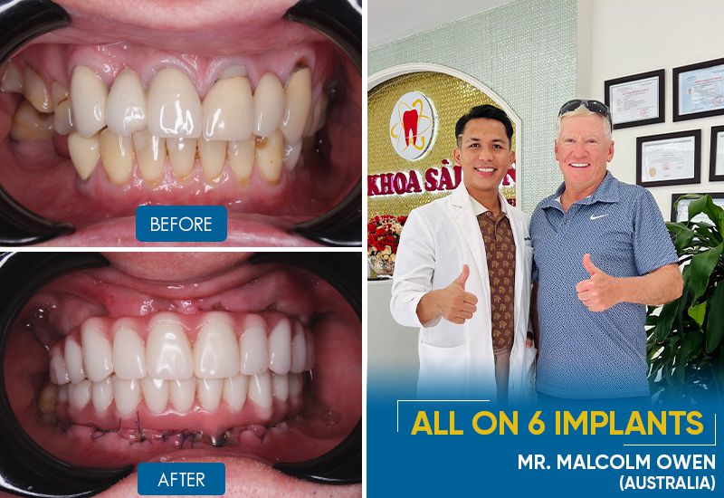 dental implants before and after
