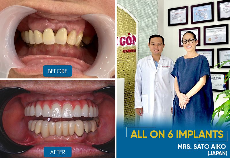 dental restoration