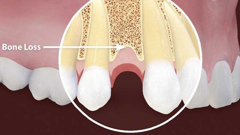 bone gafting for dental implants