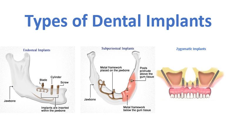 Types of dental implants