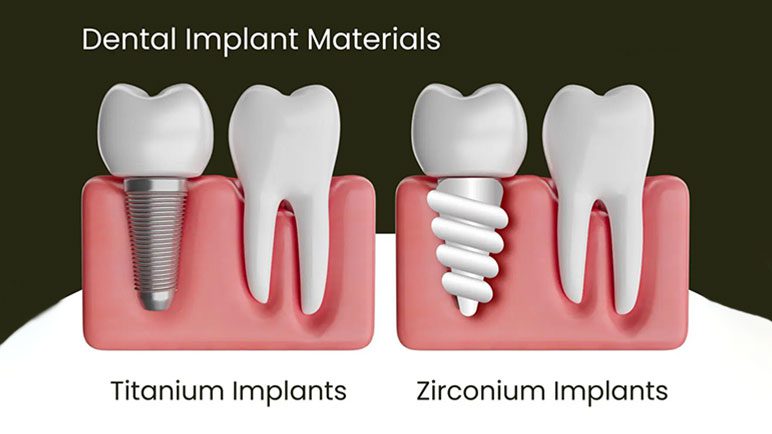 dental implants materials