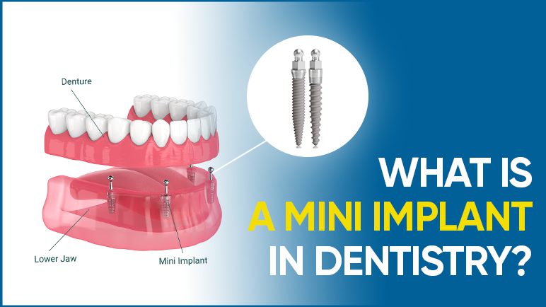 mini denture implants