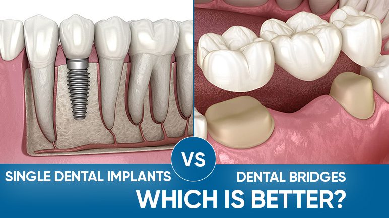 which is better an implant or a bridge