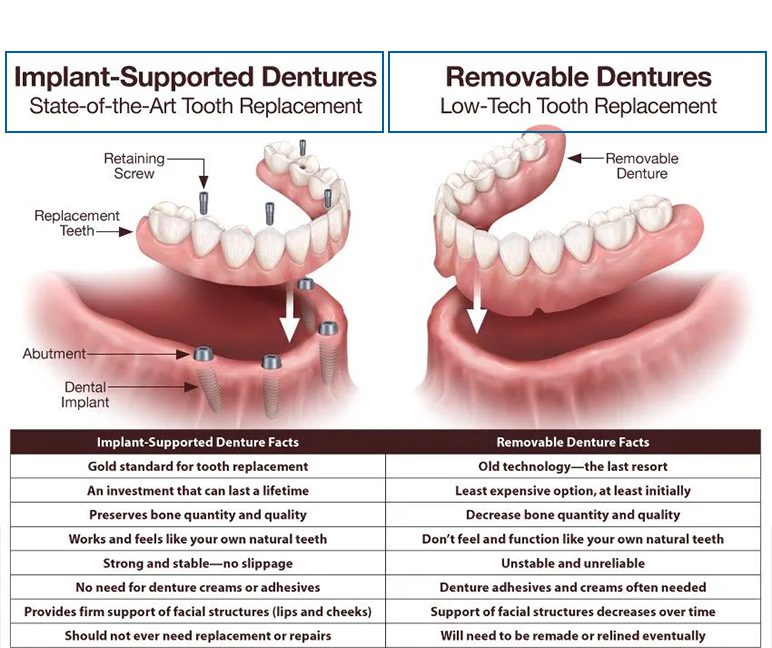 Differences between traditional dentures and implant-supported dentures