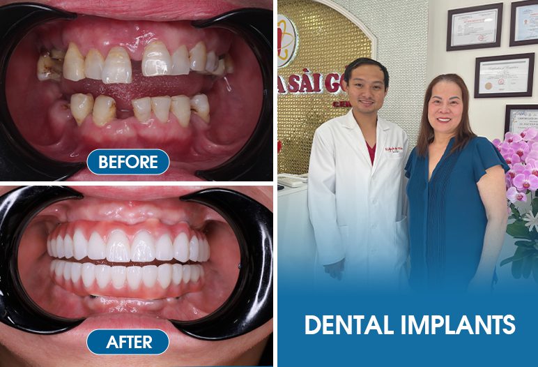 result of dental implants