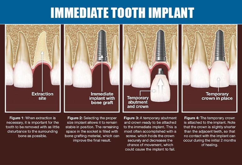 procedure of immediate tooth implant
