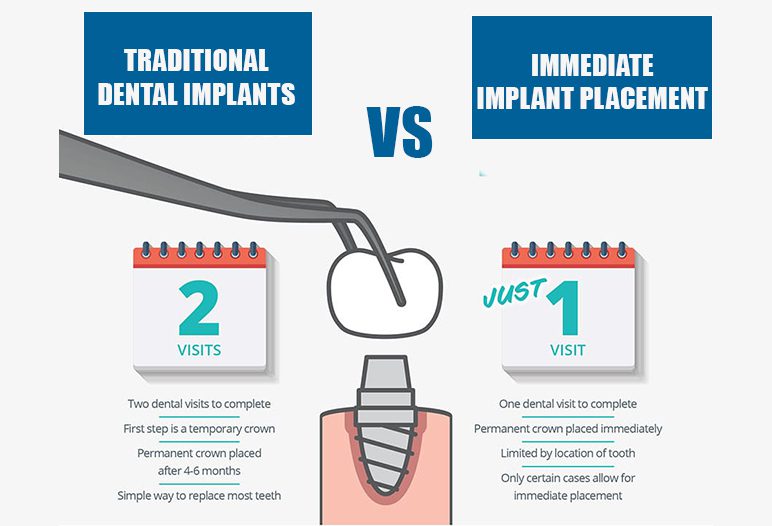 traditional dental implant vs immediate implants