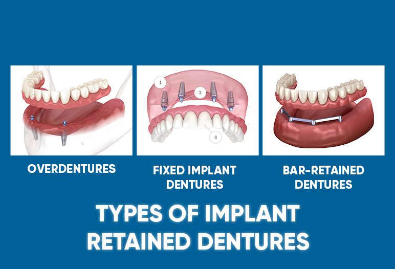 Types of implant retained dentures