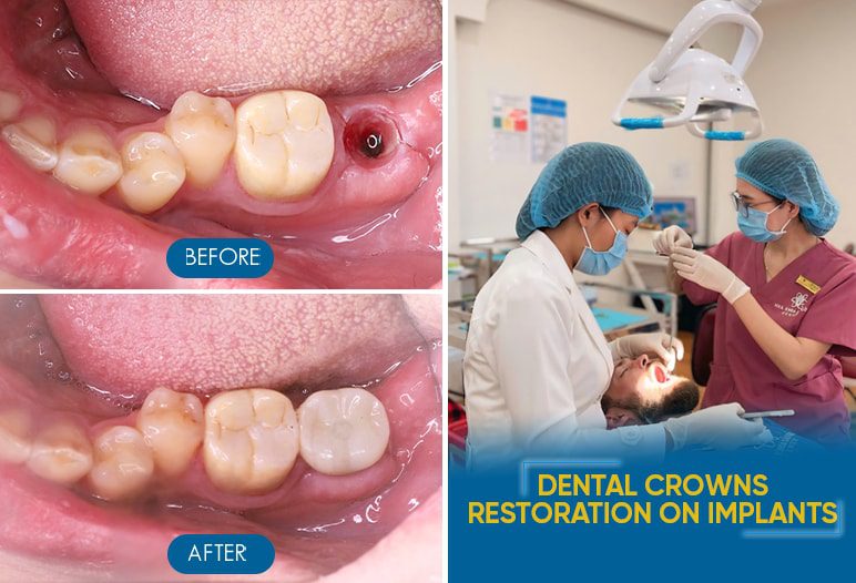 single tooth implants
