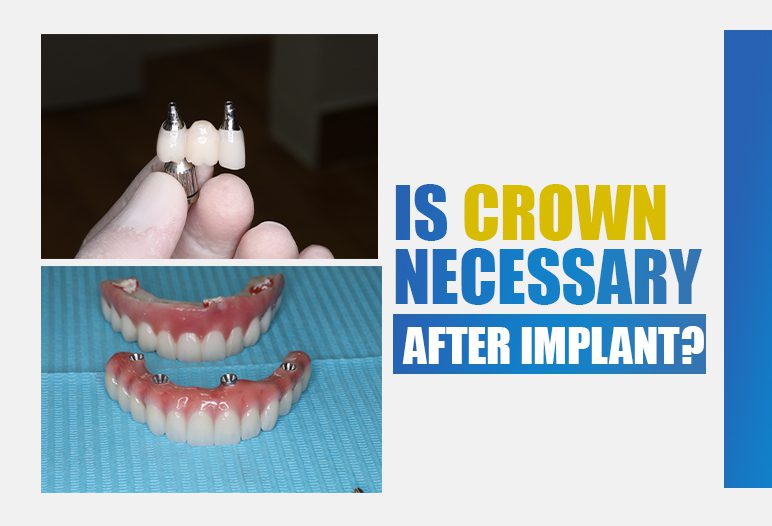 is crown necessary after implant