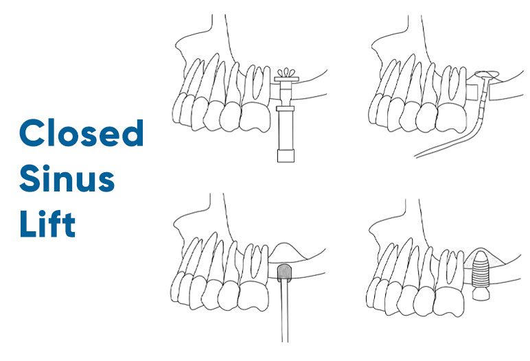 Closed Sinus Lift