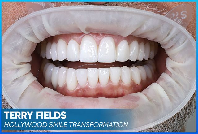 Result after the whole procedure to make a Hollywood Smile
