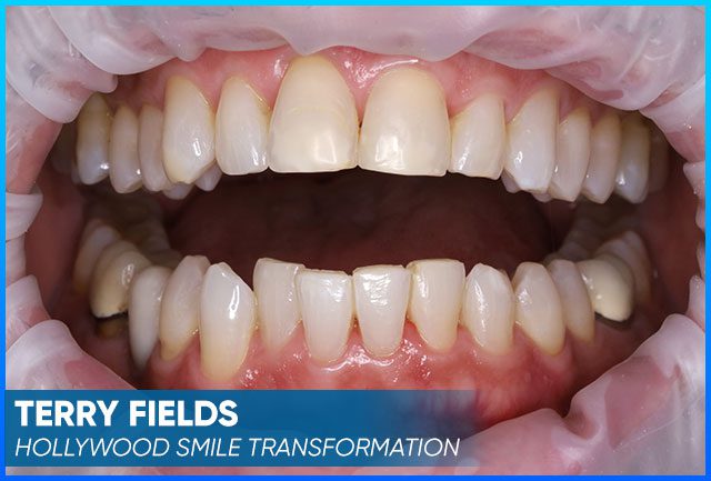 Terry's condition teeth before
