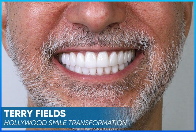 Terry's new smile
