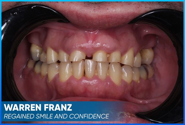 Warren Franz case before procedure