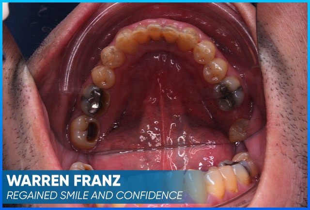 Warren Franz case before procedure