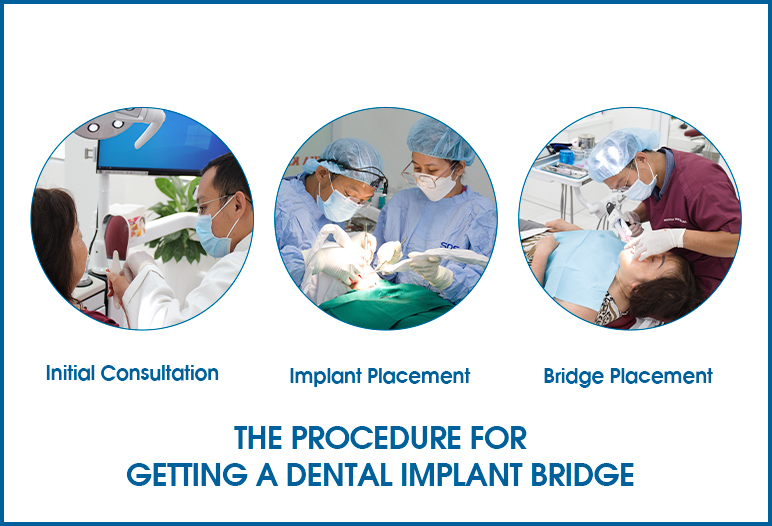 The Procedure for Getting a Dental Implant Bridge