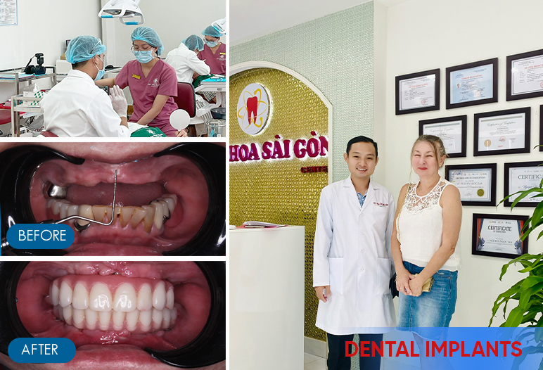 full mouth dental implants