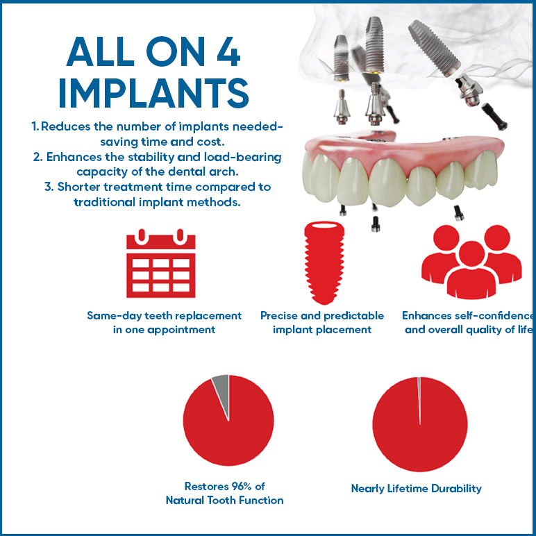 all on 4 dental implants