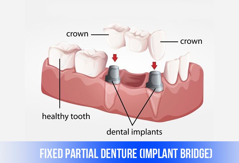 bridge implant dental