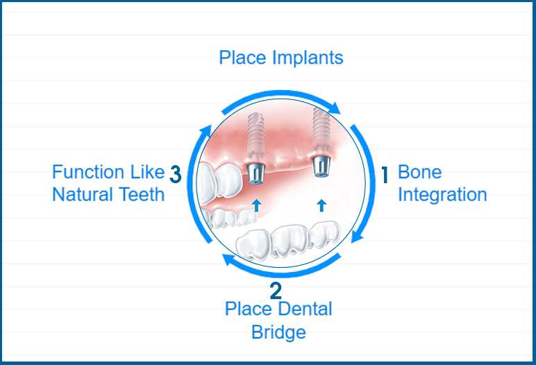 bridge tooth implant procedure