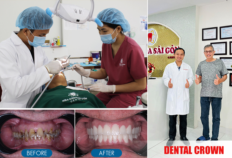 dental crown before after