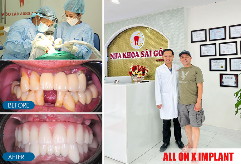 all on 6 dental implants