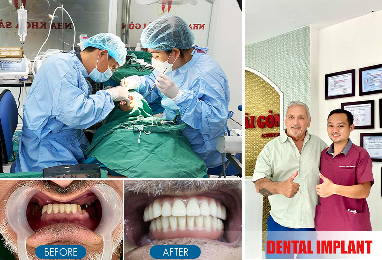 dental implant before after