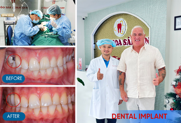 single tooth implant