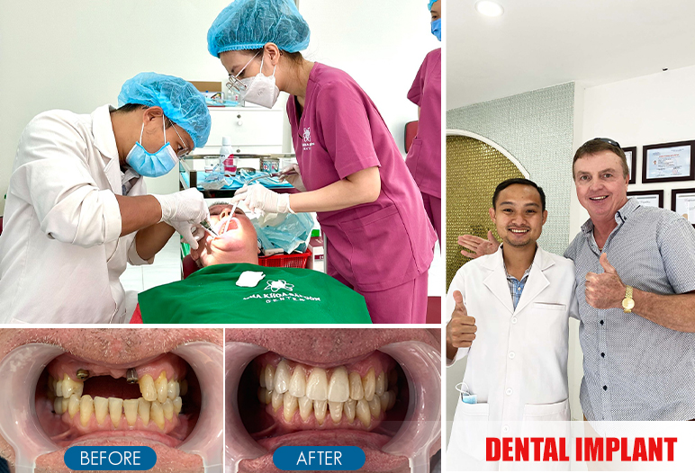 dental implant before after