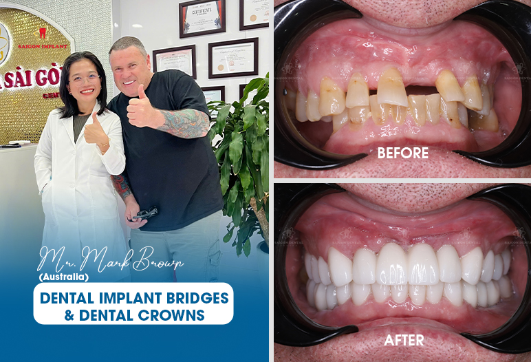 Dental Implant Bridges dental implant bridge