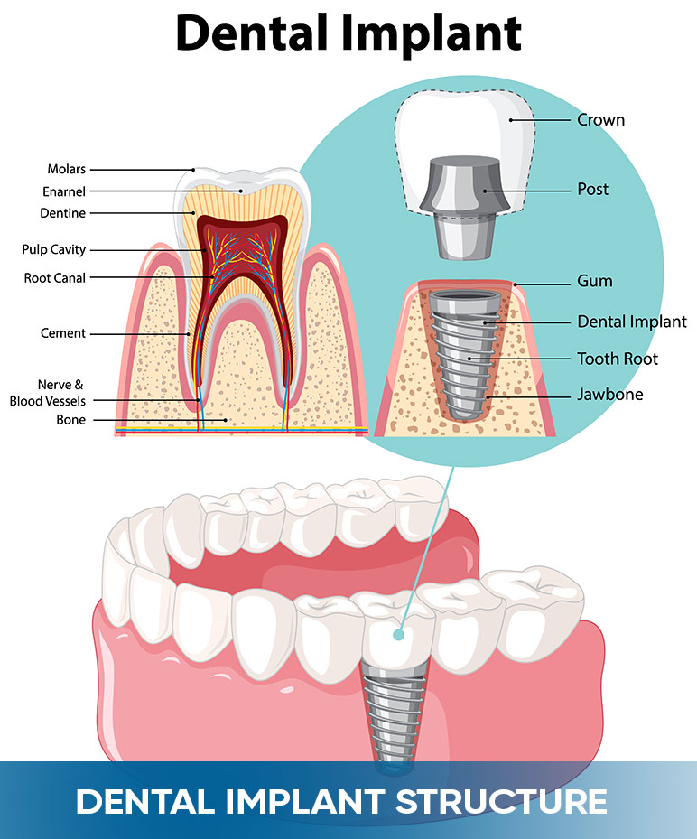 dental implant structures